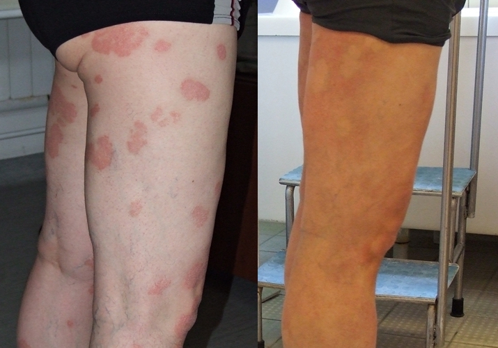 Volga régió központja a vitiligo és a pikkelysömör kezelésére)