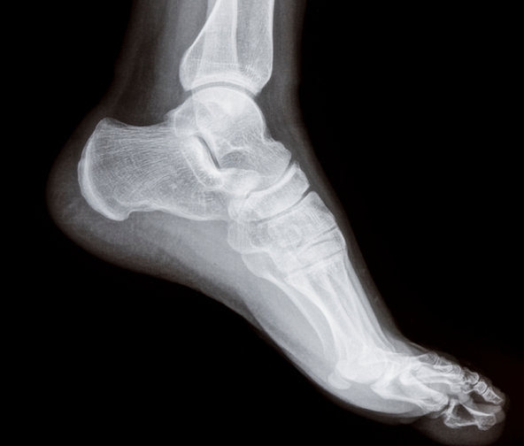 a bokaízület 1. fokozatának deformáló artrózisa fájdalom a csípőízületben egy hajlított lábakkal