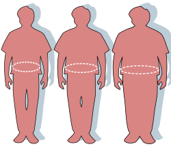  Jelentős súlycsökkentéssel elérhető a kettes típusú cukorbetegség remissziója