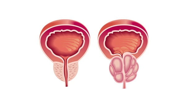 Tesztoszteronhiány: a férfi menopauza?