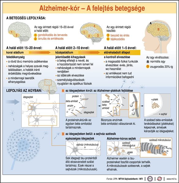 Alzheimer-kór: a felejtés betegsége