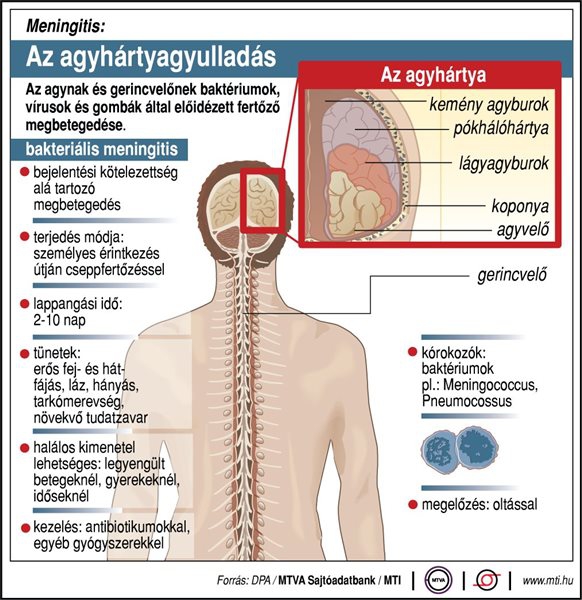 Meningitis: Az agyhártyagyulladás