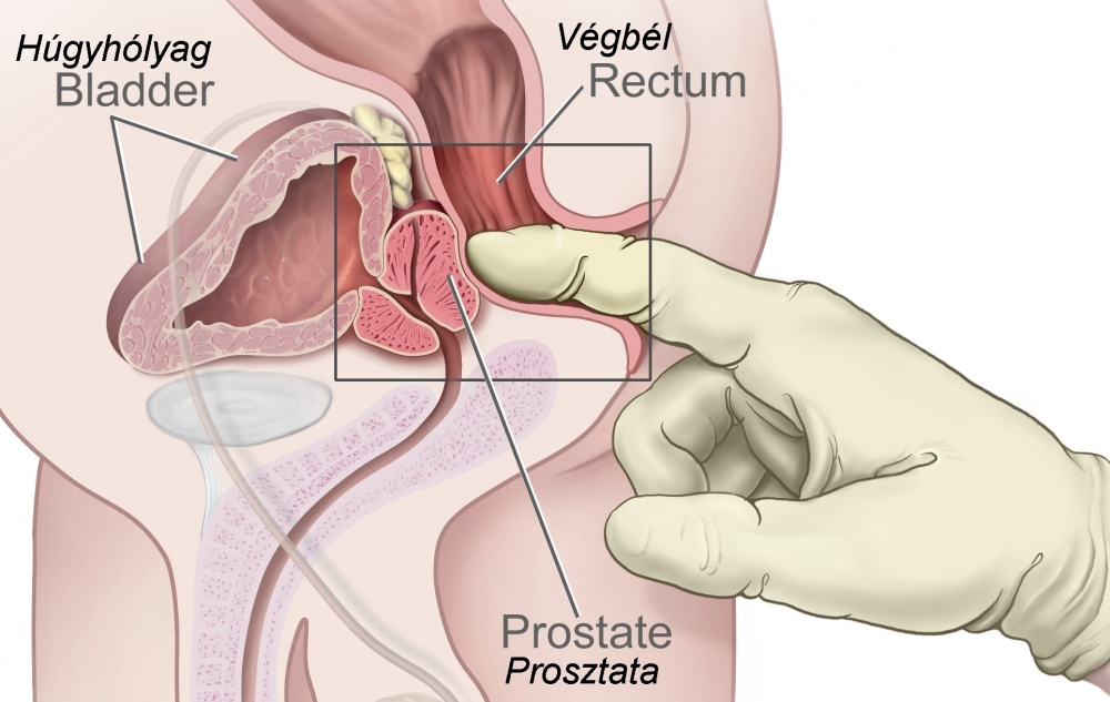 37 year old male enlarged prostate Prosztata művelet A fibrózis eltávolítása