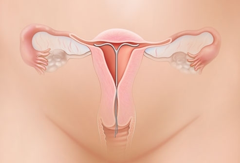 kismedencei gyulladás menstruáció