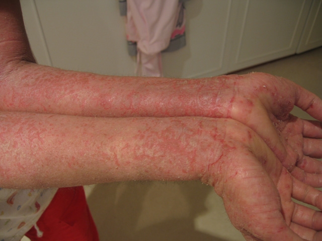 kéz bőrbetegségei