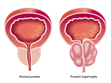 Mit jelent a prostatitis