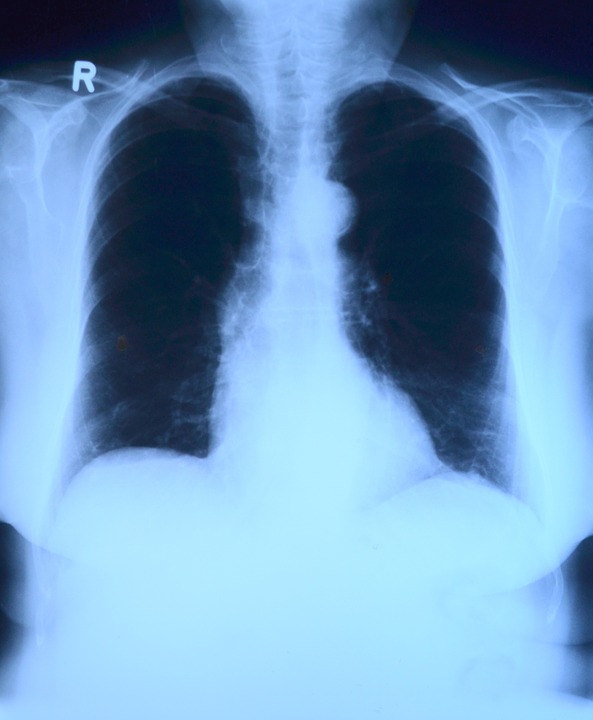 Csökkent a tbc-fertőzések száma Európában 2010 és 2014 között