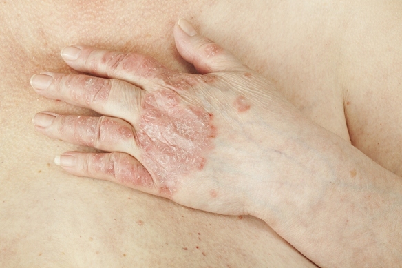 Bőrbetegségek: pikkelysömör (psoriasis) és ekcéma kezelése gyógygombákkal